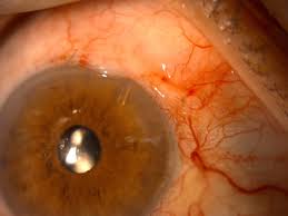 El-glaucoma-es-la-principal-causa-de-ceguera-irreversible-en.jpg