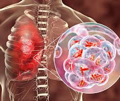 ¿Como-puede-ayudar-la-IA-en-la-endocarditis-infecciosa-–.jpg