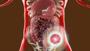 Cáncer colorectal