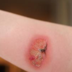 ¿Cómo se puede regenerar la piel de forma efectiva en heridas complejas? – Salud y Medicina