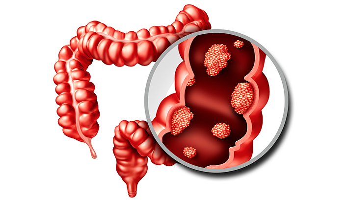 ¿A-punto-un-enfoque-innovador-para-tratar-el-cancer-colorrectal.png