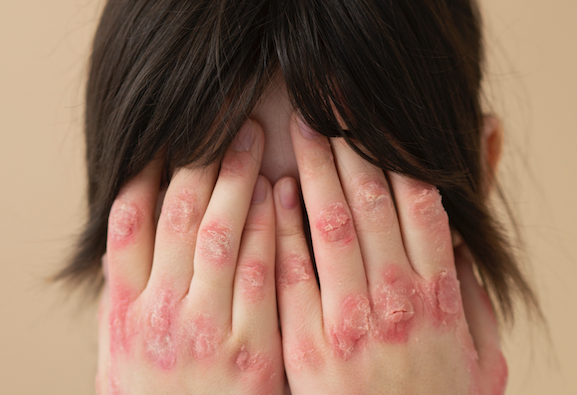 Dermatitis-atopica-un-enfoque-integral-que-mejora-la-piel-y.png