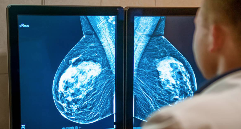 Mas-de-la-mitad-de-las-mujeres-con-el-cancer.png