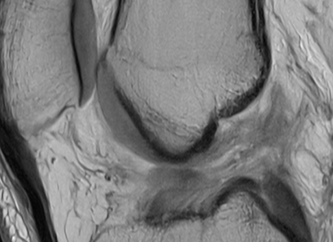 Medicina-de-precision-para-la-lesion-del-ligamento-cruzado-anterior.png