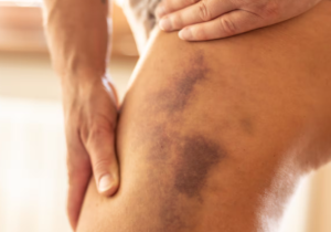 La-desconocida-enfermedad-que-esta-detras-de-menstruaciones-copiosas-y.png