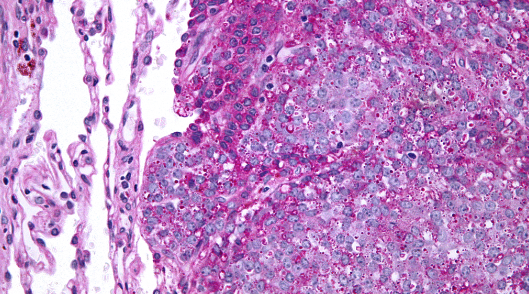 ¿Una-nueva-estrategia-terapeutica-para-el-sarcoma-de-Ewing-–.png