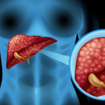 Decidir en la incertidumbre del cáncer de hígado – Salud y Medicina