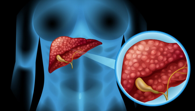 Decidir-en-la-incertidumbre-del-cancer-de-higado-–-Salud.png