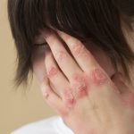 El 60% de los casos de dermatitis atópica se inician en el primer año – Salud y Medicina