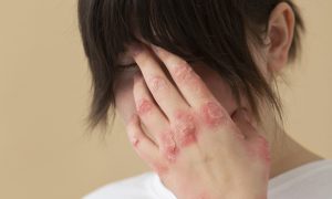 El-60-de-los-casos-de-dermatitis-atopica-se-inician.jpg