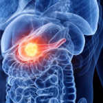 El revolucionario fármaco para cáncer de páncreas que ya empieza a beneficiar al enfermo – Salud y Medicina