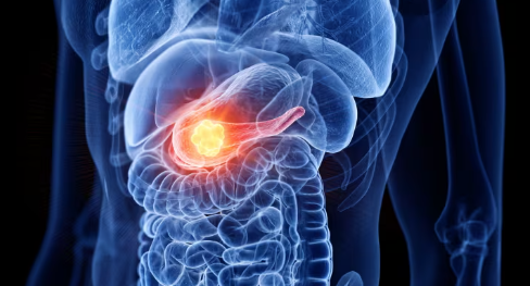 El-revolucionario-farmaco-para-cancer-de-pancreas-que-ya-empieza.png